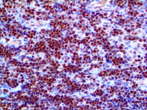 IHC of c-Myc on an FFPE Burkitt’s Lymphoma Tissue